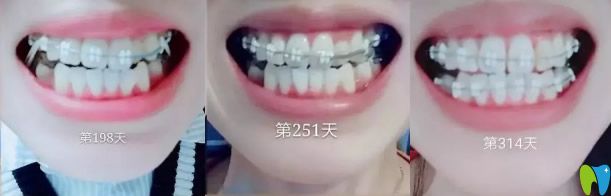陶瓷托槽隱形矯正第6個月-第10個月效果圖