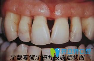 牙齦萎縮牙槽骨吸收圖