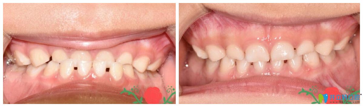 孩子地包天矯正效果怎么樣？來(lái)看一下真實(shí)案例吧