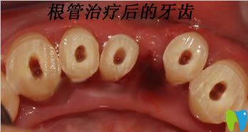 做過根管治療后的牙齒圖 做過根管治療后的牙齒圖