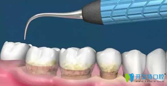 牙齒黑三角的治療方法