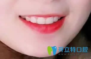 我在西安優(yōu)德口腔做牙齒矯正15個(gè)月效果