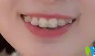 我在西安優(yōu)德口腔戴牙套第8個(gè)月變化