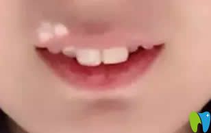 我在西安優(yōu)德口腔戴牙套第2個(gè)月