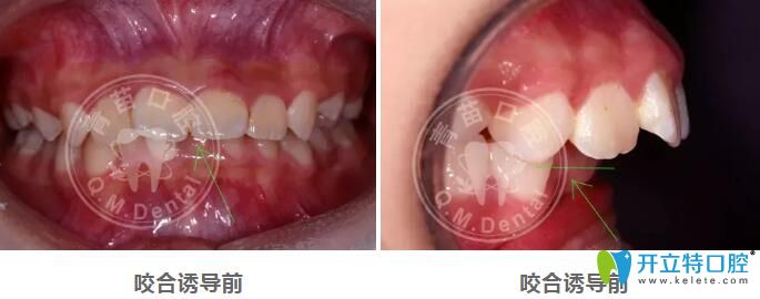 兒童咬合誘導(dǎo)哪家好？深圳青苗口腔羅慕咬合矯正案例驗證