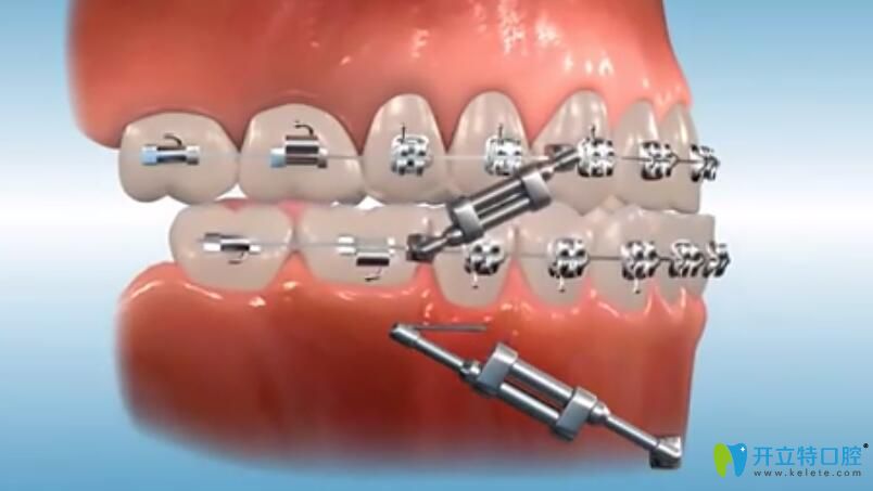 托槽矯正中醫(yī)生在后期是如何調整咬合關系的