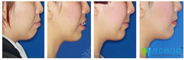 重慶茁悅口腔好不好？真人案例效果見(jiàn)證奇跡