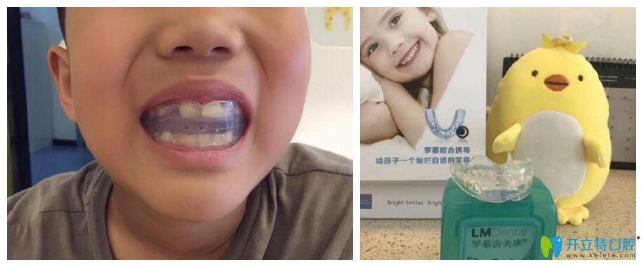 重慶牙齒矯正哪里好？茁悅口腔牙齒正畸案例效果來(lái)說(shuō)明