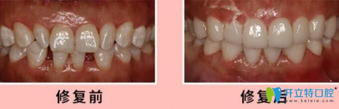 胡永瓷貼面修復牙齒案例