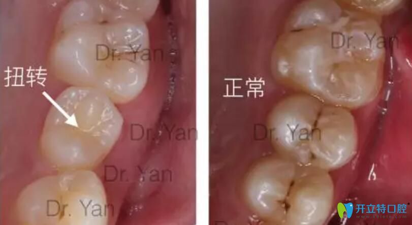 牙齒咬合關系對比圖