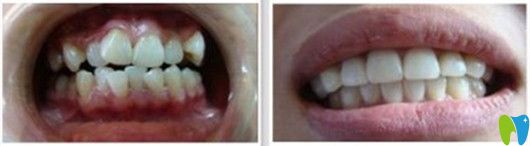 <!--<i data=20240703-sp></i>-->正畸圖