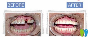 種植牙前后對比照