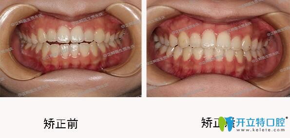 成都口腔哪里正畸好？圣貝口腔牙齒矯正效果來揭曉