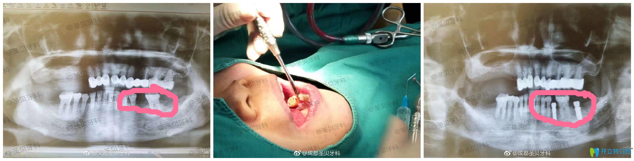 圣貝口腔種牙怎么樣？案例效果來驗證