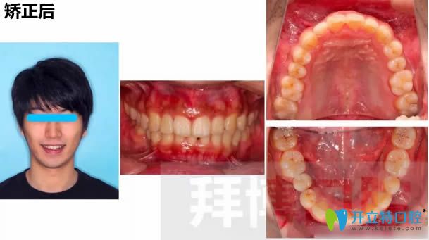 小張在拜博口腔戴牙套一年后的矯正效果