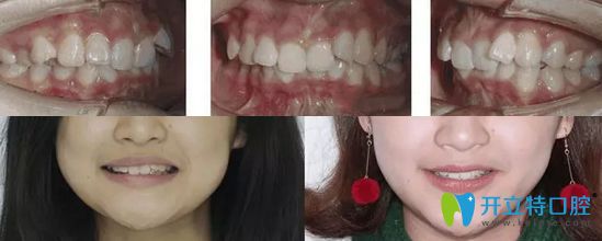 深覆合矯正前后對比照片