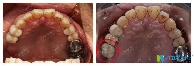 廈門登特口腔為60歲高血壓患者進(jìn)行種牙案例
