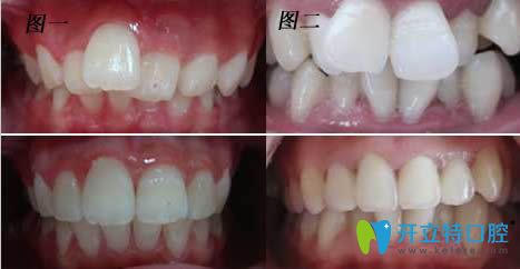 鄭州唯美齒科牙列不齊矯正案例效果圖