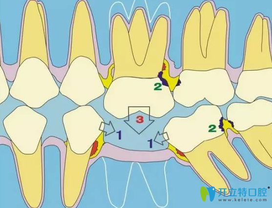 拔牙會導致旁邊的牙齒松動嗎?流傳年輕人不能拔牙是真的嗎