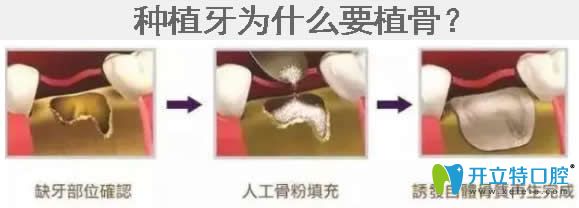 做種植牙為什么要植骨