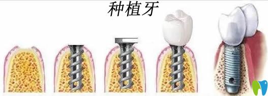 種植牙國產好還是進口好?國產種植體和進口種植體區(qū)別在哪