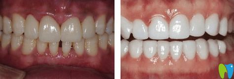 西安諾貝爾口腔瓷貼面變化圖