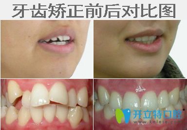 牙齒錯(cuò)亂矯正前后對(duì)比圖