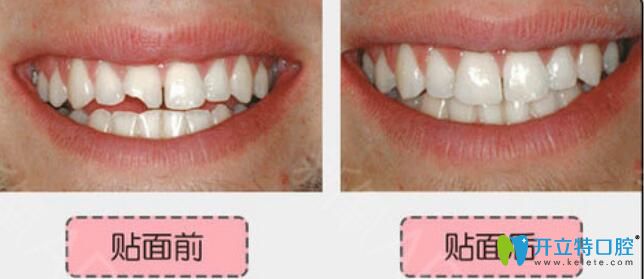 無錫北極星口腔楊亮亮怎么樣？真人案例及反饋來驗證