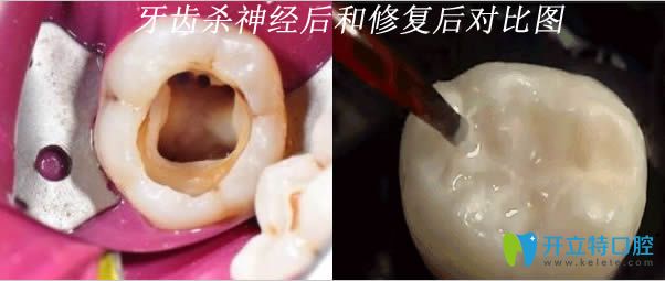 牙齒殺神經(jīng)后和修復后的對比圖