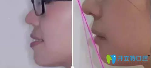 35歲顧客齙牙牙齒矯正案例對(duì)比圖