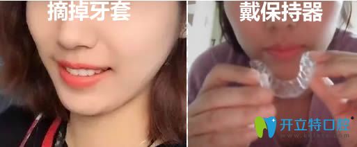 33歲的我戴舌側(cè)隱形牙套12個月矯正效果