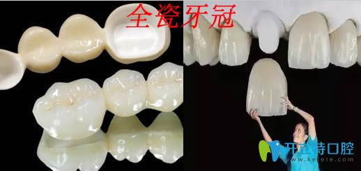 牙醫(yī)都推薦二氧化鋯全瓷牙的原因是什么