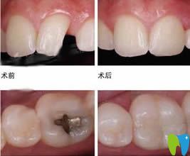 重慶牙博士口腔補(bǔ)牙前后對(duì)比圖