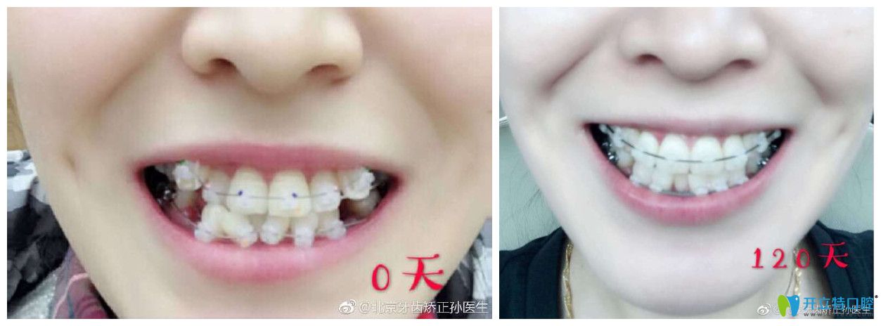 北京中諾口腔劉興華正畸怎么樣？案例效果來驗(yàn)證