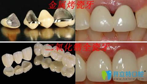 二氧化鋯全瓷牙和金屬烤瓷牙區(qū)別圖片