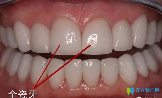 全瓷牙產(chǎn)地影響價格的，來看深圳進口/國產(chǎn)全瓷牙多少錢一顆