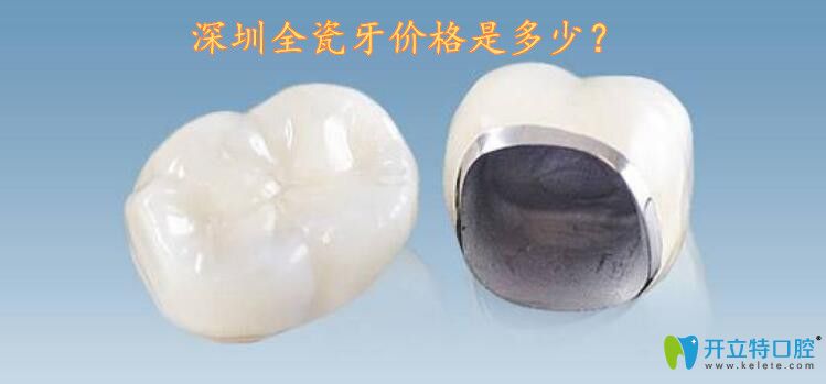 深圳全瓷牙價格是多少呢