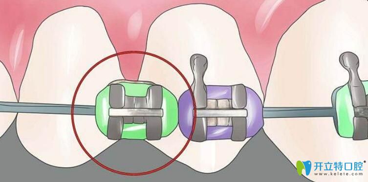什么是自鎖托槽矯正技術(shù),價(jià)格是多少?戴自鎖矯正器過(guò)程圖解