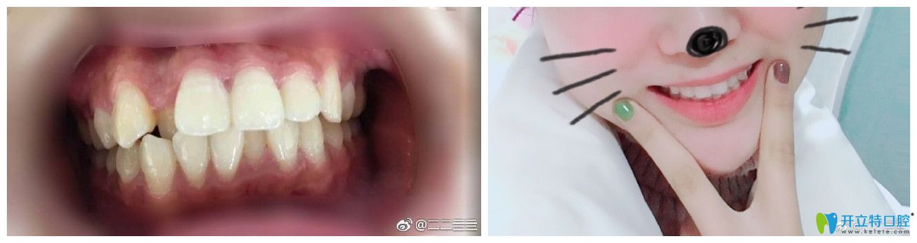 北京中諾口腔孫金鑫牙齒矯正好不好？案例效果來證明
