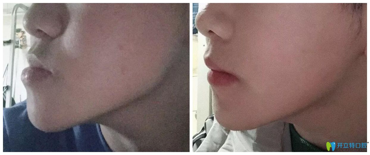正頜手術(shù)前后對(duì)比臉型圖