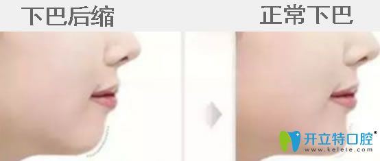 下巴后縮帶牙套有用嗎？真相揭秘下巴后縮矯正后堪比整容