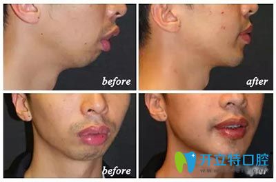 下巴后縮矯正前后對(duì)比圖