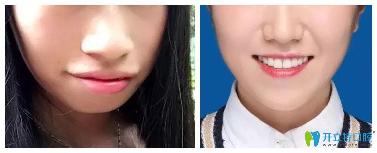 牙齒正畸對臉型的影響？看牙齒矯正案例效果前后對比圖