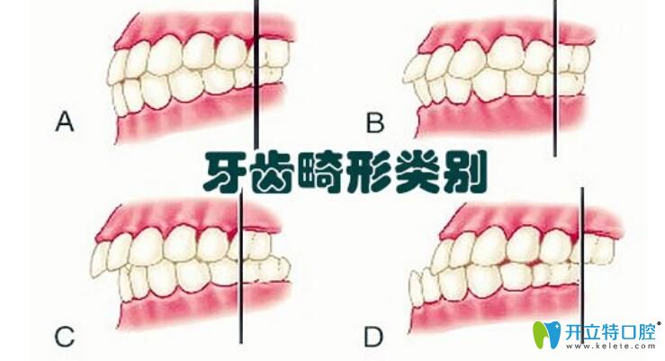 牙齒矯正為甚那么貴