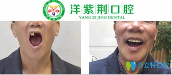 <!--<i data=20240703-sp></i>-->全口種植牙前后對比效果圖