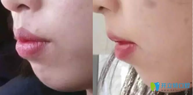 在欣雅口腔做牙齒矯正的側顏對比照