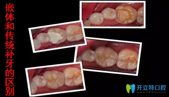 嵌體和傳統(tǒng)補(bǔ)牙的區(qū)別