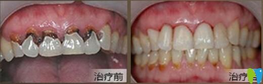 北京中諾口腔好不好？郭祖迎牙齒修復(fù)案例效果來驗(yàn)證