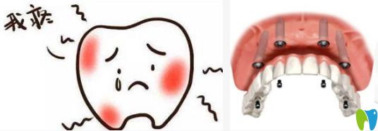 究竟做種植牙疼不疼/術(shù)后大概疼幾天？聽資深醫(yī)生親自回答