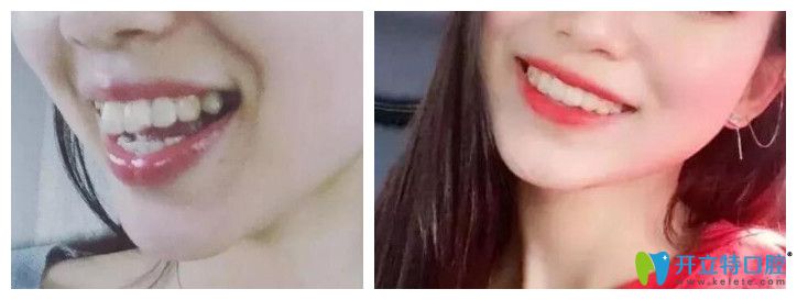 牙齒矯正能改變臉型嗎？看維樂口腔<!--<i data=20240703-sp></i>-->齙牙矯正前后對比圖